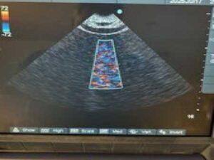 SONOSITE MICROMAXX ULTRASOUND SYSTEM