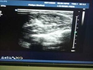 Philips IU22 Ultrasound Unit With Two Transducers C5-1 and L12-5