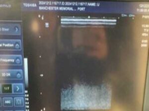 Toshiba Viamo SSA-640A Portable Ultrasound | MFG 2010 | with PLT-704ST Probe